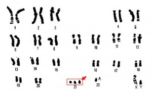 cromosomas_sindromeDown